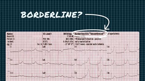 boardline ecg|borderline ecg mayo clinic.